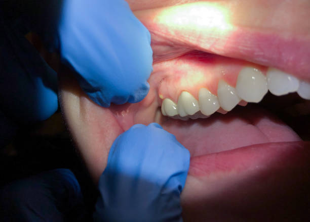 Best Emergency Dentist for Lost Fillings or Crowns in Mastic, NY