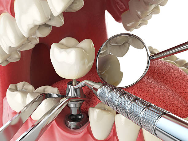 Best Emergency Root Canal Treatment in Mastic, NY